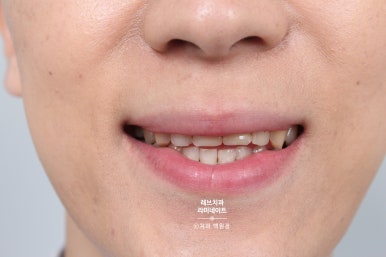 레브네이트 엑스퍼트 ; 유튜버가 선택한 앞니 라미네이트. 앞니 레진 벌어짐을 자연스러우면서 화사하게 바꿔봅시다. 신사역 치과. 치료후기/비용/가격. 관련 이미지 10