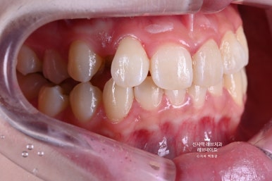 신사역 치과. 아나운서 면접 전 앞니 벌어진 공간을 라미네이트로만 해결할 수 있었던 사연.. 관련 이미지 20