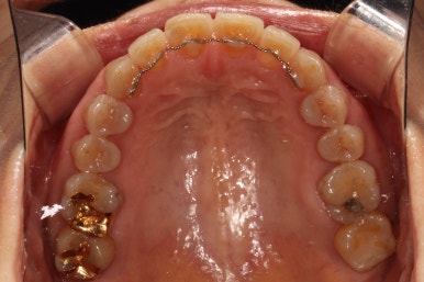 삐뚤어진 앞니를 8개월만에 가지런하게 만드는 50대 성인부분교정. 신사역 교정치과. 치료과정/기간/비용. 관련 이미지 28