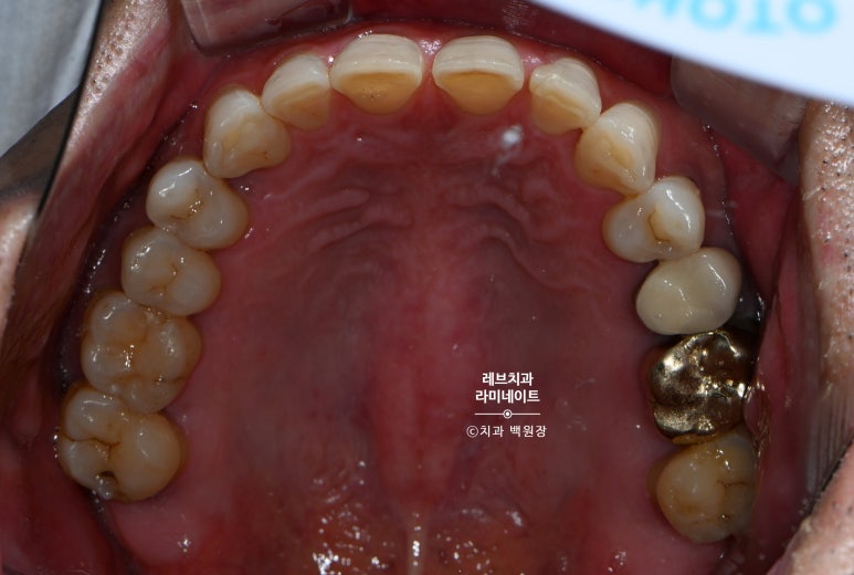 신사역 무삭제 라미네이트 : 레브네이트 내츄럴 최소삭제 비니어. 50대 앞니 벌어짐 비용/후기/얼굴사진. 관련 이미지 3