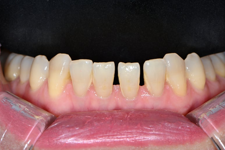 레브네이트 엑스퍼트 - 앞니 무삭제 라미네이트. 40대 벌어진 앞니에 변색된 레진은 이제 그만! 압구정 치과 추천 전후/비용. 관련 이미지 7