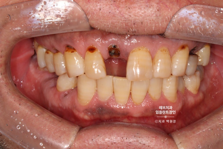 앞니 부러짐? 뽑고 바로 임플란트 + 뼈이식. 앞니 흔들림? 뽑고 1달 기다리고 임플란트 + 뼈이식. 신사역 치과 후기/비용/과정. 관련 이미지 2