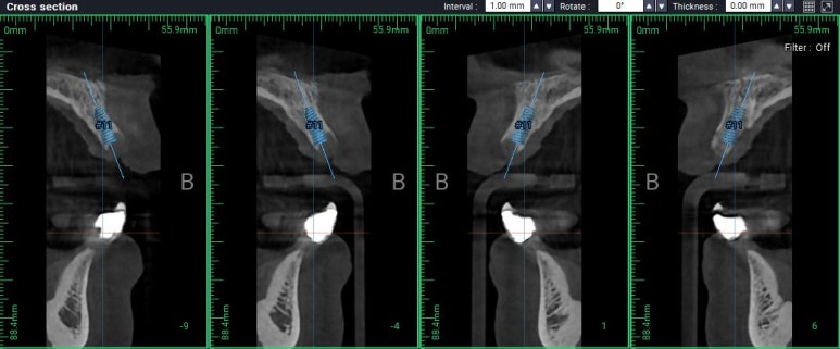 앞니가 풍치로 흔들거려요. 심한 치주염인데 임플란트 가능할까요? 치료과정/치료기간/비용/성공후기. 신금호역 치과 추천. 관련 이미지 13