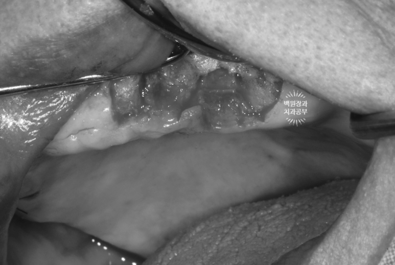 임플란트에서 고름이 나와요. 임플란트 주위염 그리고 재수술을 위한 준비. 치료과정/치료기간/비용/후기. 관련 이미지 9