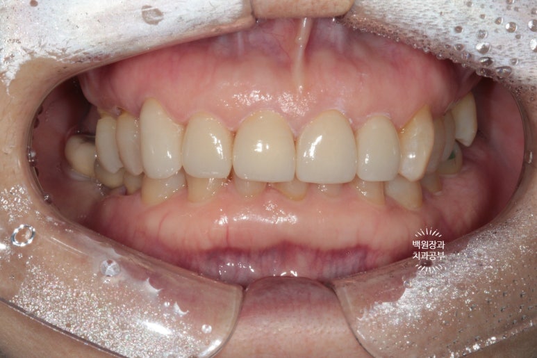 삐뚤빼뚤 앞니 세로 금  - 신경치료 없이 지르코니아 크라운으로. 상악동뼈이식술 임플란트. 관련 이미지 12