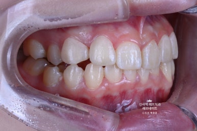신사역 치과. 아나운서 면접 전 앞니 벌어진 공간을 라미네이트로만 해결할 수 있었던 사연.. 관련 이미지 26