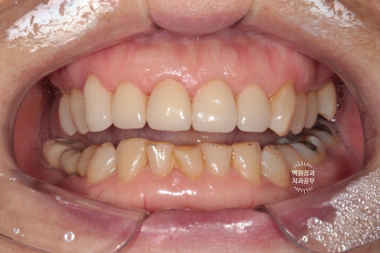 삐뚤빼뚤 앞니 세로 금  - 신경치료 없이 지르코니아 크라운으로. 상악동뼈이식술 임플란트. 관련 이미지 10