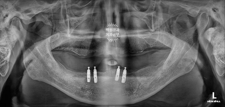 불편한 틀니를 아직도 쓰시나요? 전체 임플란트 치료비용/치료기간/치료과정. 관련 이미지 2