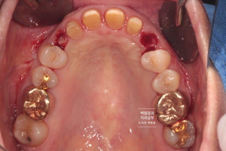 크라운 앞니 충치로 냄새가 나요 - 최소한의 임플란트와 씌우는 치료. 치료과정/기간/비용. 관련 이미지 8