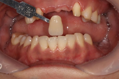 전세계 1위 스트라우만 임플란트를 사용한 어금니 기능회복과 앞니 지르코니아 크라운 증례. 관련 이미지 15