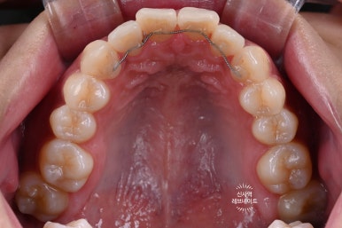 What About Laminates at Sinsa Station? Rev Dental Clinic’s Revnate. image 6