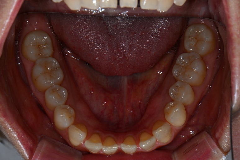 레브네이트 엑스퍼트 - 앞니 무삭제 라미네이트. 40대 벌어진 앞니에 변색된 레진은 이제 그만! 압구정 치과 추천 전후/비용. 관련 이미지 8