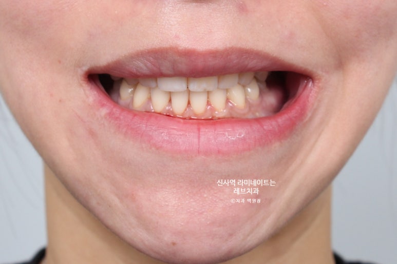 신사역 라미네이트, 잘하는 치과의 치료과정과 재료.설명.비용.후기. 관련 이미지 11