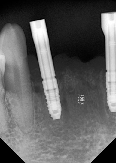 Seoul Sinsa Station [Lev Dental Clinic] For chronic periodontitis, extract the lower front teeth and make the crown look even more real than the real thing with an implant. image 7