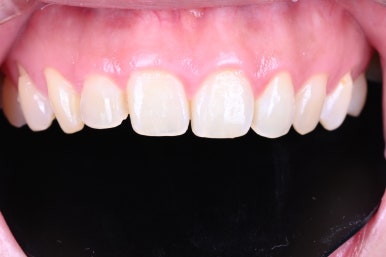 신사역 라미네이트. 결혼식 전 앞니 고민, 얇은 세라믹 레브네이트로 해결! 관련 이미지 6