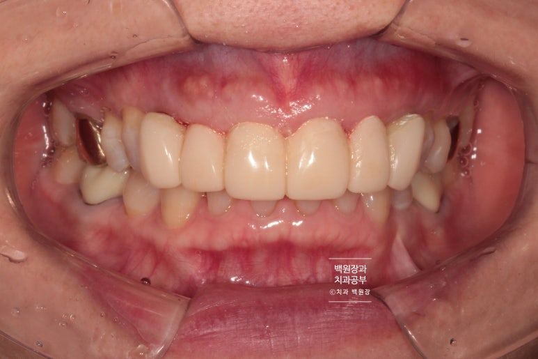 크라운 앞니 충치로 냄새가 나요 - 최소한의 임플란트와 씌우는 치료. 치료과정/기간/비용. 관련 이미지 7