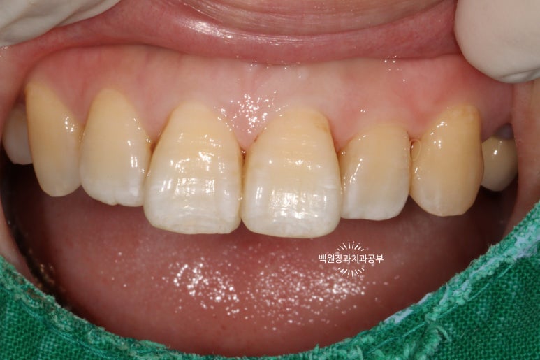 앞니레진치료 할 줄 모르는 치과의사는 없지만, 좋은 레진으로 치료하는 치과의사는 잘 없습니다. 관련 이미지 25