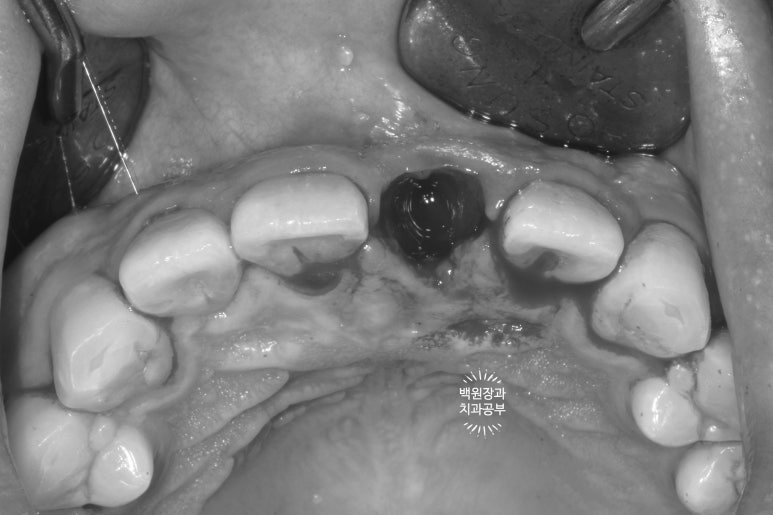 앞니 머리가 기둥째 부러졌어요. 발치 동시 뼈이식 오스템 BA 임플란트. 치료과정/치료기간/비용/후기. 압구정 치과. 관련 이미지 5