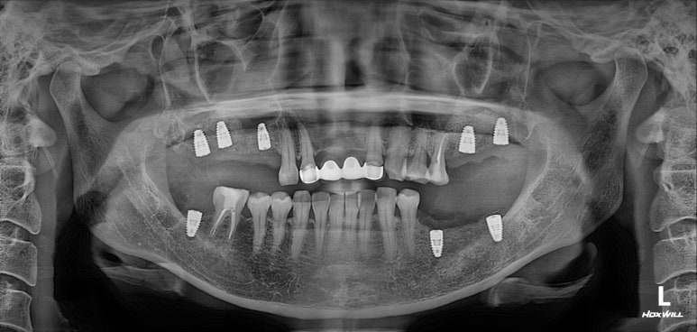 전세계 1위 스트라우만 임플란트를 사용한 어금니 기능회복과 앞니 지르코니아 크라운 증례. 관련 이미지 12