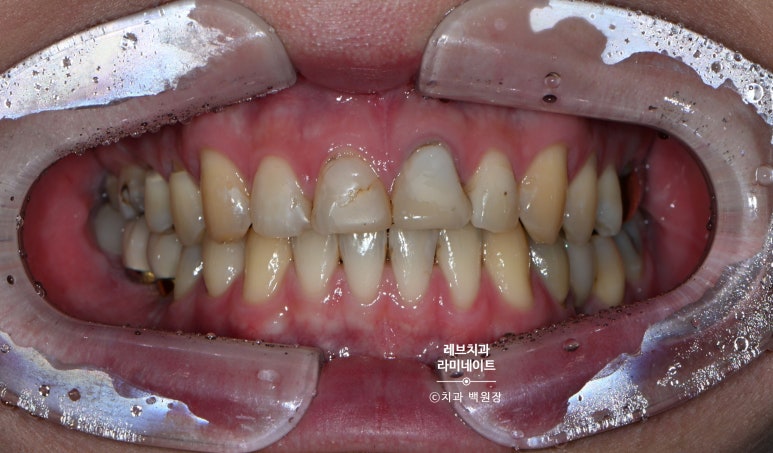 레브네이트 엑스퍼트 ; 유튜버가 선택한 앞니 라미네이트. 앞니 레진 벌어짐을 자연스러우면서 화사하게 바꿔봅시다. 신사역 치과. 치료후기/비용/가격. 관련 이미지 2