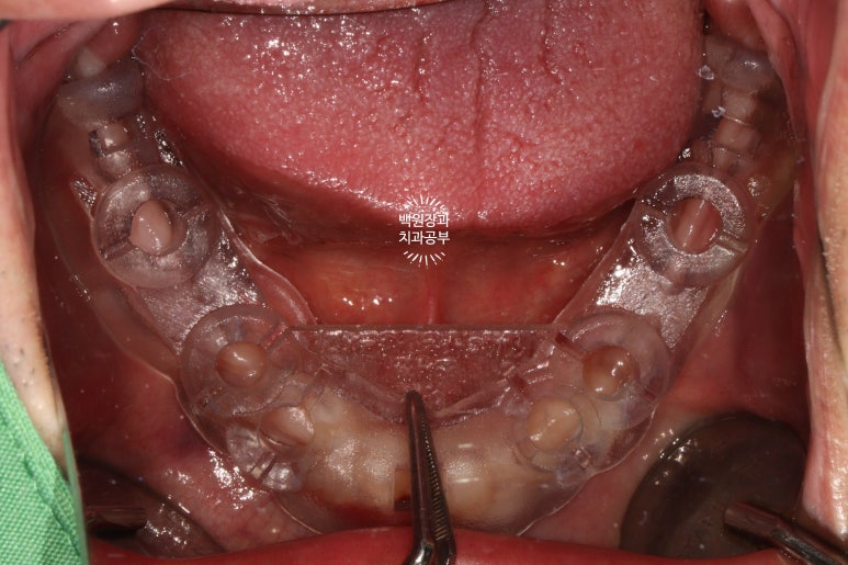 만성치주염으로 인해 아주 좁아진 잇몸뼈에 광범위한 뼈이식 + 전체임플란트. 신사 레브치과. 관련 이미지 32