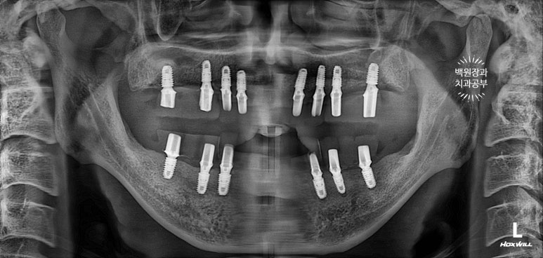 만성치주염으로 인해 아주 좁아진 잇몸뼈에 광범위한 뼈이식 + 전체임플란트. 신사 레브치과. 관련 이미지 49