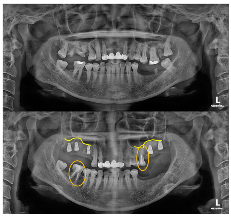 전세계 1위 스트라우만 임플란트를 사용한 어금니 기능회복과 앞니 지르코니아 크라운 증례. 관련 이미지 11