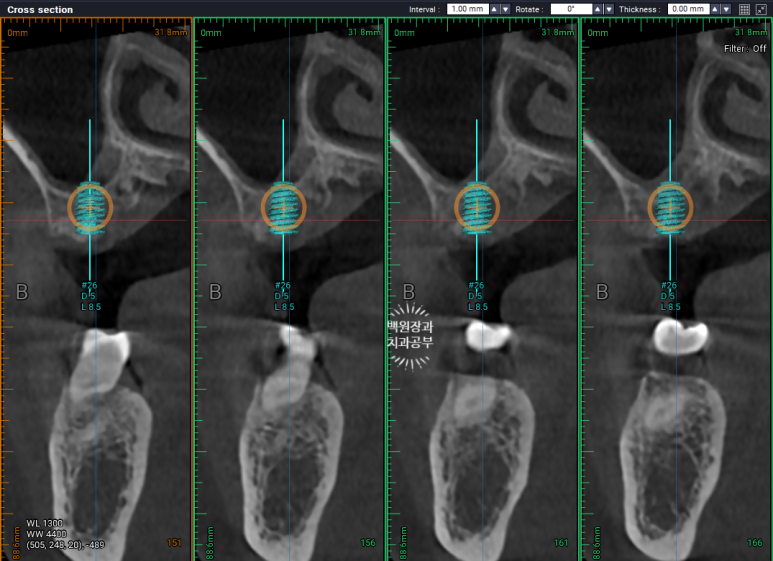 치아와 임플란트를 연결하면 치아가 망가집니다. 발치 동시 치조골 이식 후 임플란트. 치료과정/치료기간/비용/후기. 관련 이미지 12