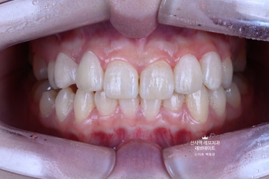 신사역 치과. 아나운서 면접 전 앞니 벌어진 공간을 라미네이트로만 해결할 수 있었던 사연.. 관련 이미지 31
