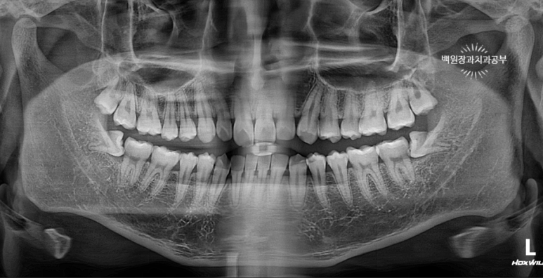 매복 사랑니 10분만에 뽑기! 치료과정/치료기간/비용/후기. 관련 이미지 2
