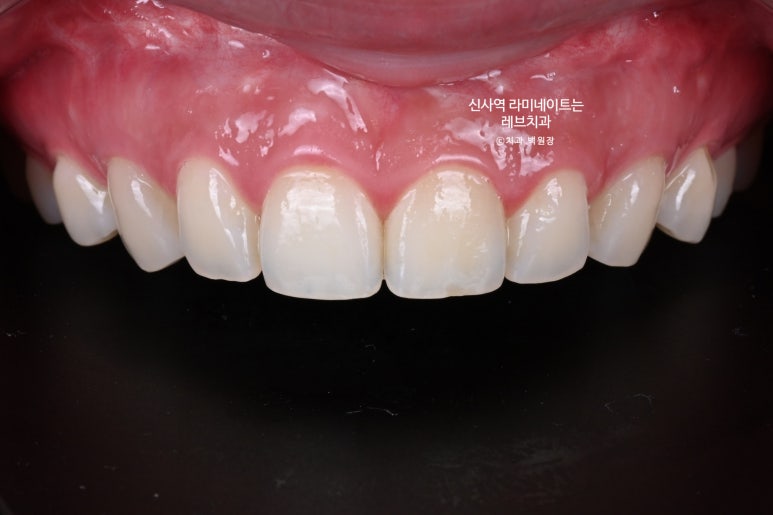 신사역 라미네이트, 잘하는 치과의 치료과정과 재료.설명.비용.후기. 관련 이미지 7