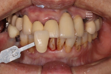 스트라우만 임플란트로 이뽑고 바로심는치과 - 믿고 사용하는 세계 1위 스위스 임플란트 회사. 관련 이미지 19