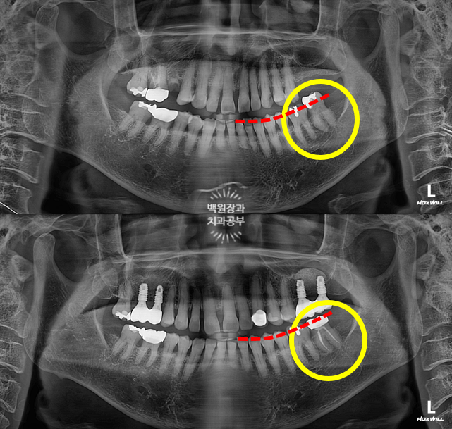 아래 어금니가 없어 위 어금니가 내려왔어요. 부분 교정을 곁들인 스트라우만 임플란트 수술. 억울한 신경치료를 피해보자. 치료과정/치료기간/비용/후기. 관련 이미지 5