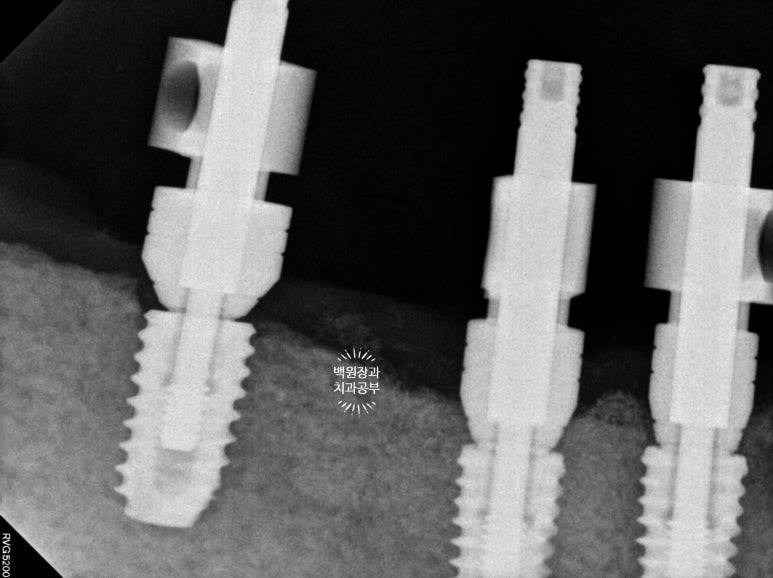 만성치주염으로 인해 아주 좁아진 잇몸뼈에 광범위한 뼈이식 + 전체임플란트. 신사 레브치과. 관련 이미지 45