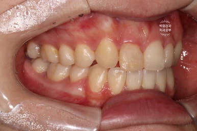 잇몸 성형과 치아미백 그리고 지르코니아 20대 앞니 크라운 치료. 치료과정/기간/비용. 관련 이미지 4