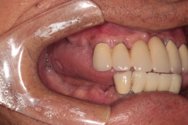 잇몸 염증 고름이 심했던 부위 - 만성치주염 진단하고 임플란트로 깔끔하게 치료! 신사역 치과 관련 이미지 10