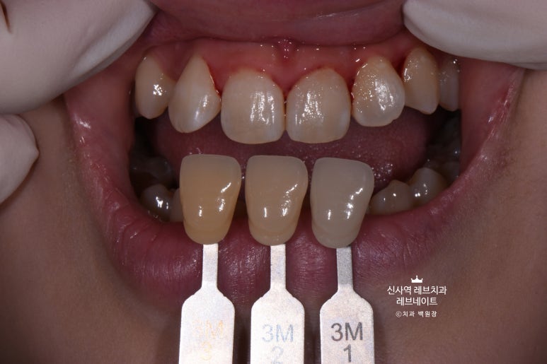 신사역 치과. 아나운서 면접 전 앞니 벌어진 공간을 라미네이트로만 해결할 수 있었던 사연.. 관련 이미지 11