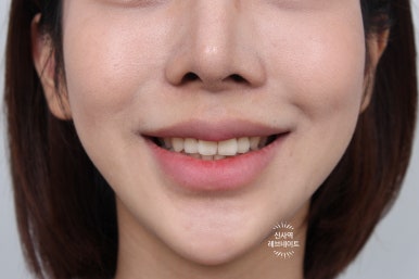 What About Laminates at Sinsa Station? Rev Dental Clinic’s Revnate. image 10