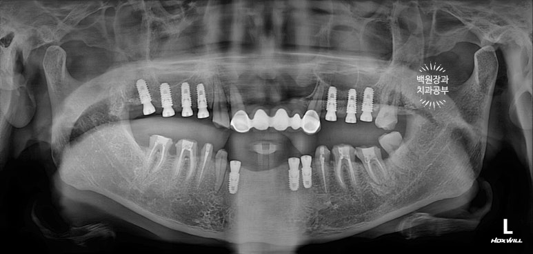 뿌리만 남은 앞니, 어금니가 없어 교합이 무너진 증례. 흡연자의 전체 오스템BA임플란트 재건증례. 치료과정/치료기간/비용/후기. 관련 이미지 17