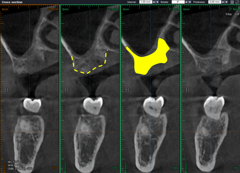 치아와 임플란트를 연결하면 치아가 망가집니다. 발치 동시 치조골 이식 후 임플란트. 치료과정/치료기간/비용/후기. 관련 이미지 11