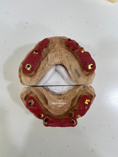 오스템임플란트 네비게이션 전체 임플란트 치료일기. 치료과정/치료기간/비용/솔직후기. 관련 이미지 24