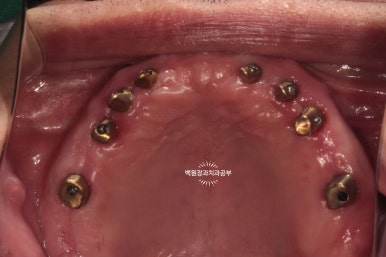 오스템임플란트 네비게이션 전체 임플란트 치료일기. 치료과정/치료기간/비용/솔직후기. 관련 이미지 29