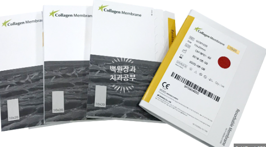 치아와 임플란트를 연결하면 치아가 망가집니다. 발치 동시 치조골 이식 후 임플란트. 치료과정/치료기간/비용/후기. 관련 이미지 9