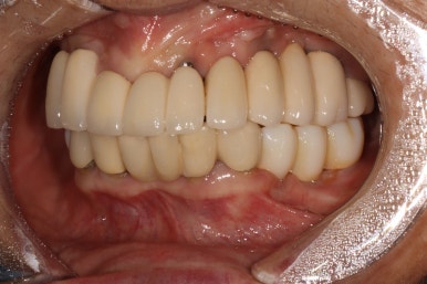 부분틀니를 오래써서 어금니가 아플 때, 아래턱 양쪽 어금니 임플란트 잘하는 강남임플란트치과 관련 이미지 20