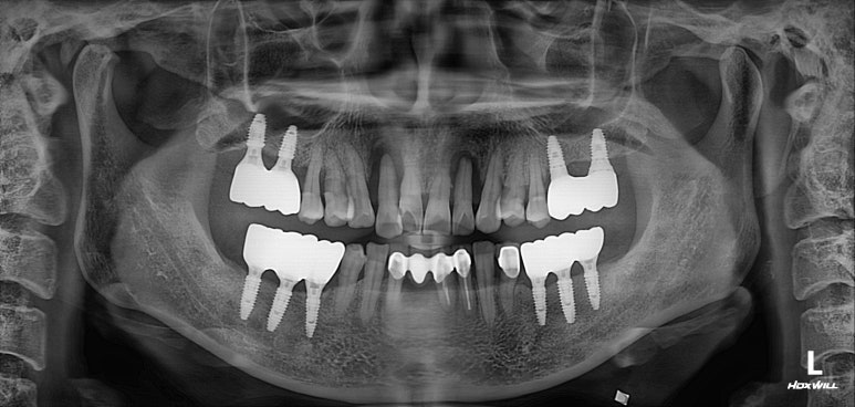 앞니가 풍치로 흔들거려요. 심한 치주염인데 임플란트 가능할까요? 치료과정/치료기간/비용/성공후기. 신금호역 치과 추천. 관련 이미지 5