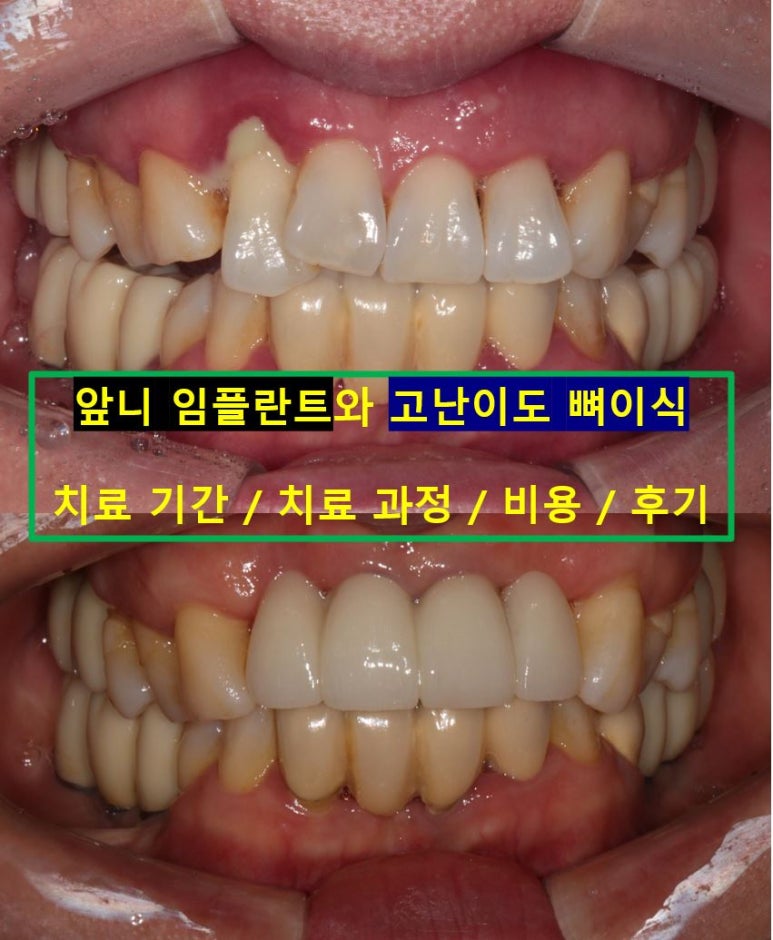 앞니가 풍치로 흔들거려요. 심한 치주염인데 임플란트 가능할까요? 치료과정/치료기간/비용/성공후기. 신금호역 치과 추천. 관련 이미지 1