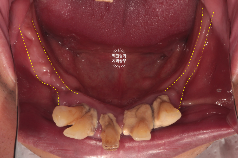 만성치주염으로 인해 아주 좁아진 잇몸뼈에 광범위한 뼈이식 + 전체임플란트. 신사 레브치과. 관련 이미지 9