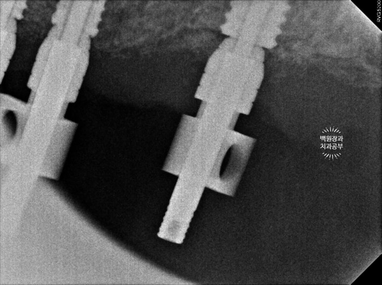 만성치주염으로 인해 아주 좁아진 잇몸뼈에 광범위한 뼈이식 + 전체임플란트. 신사 레브치과. 관련 이미지 48