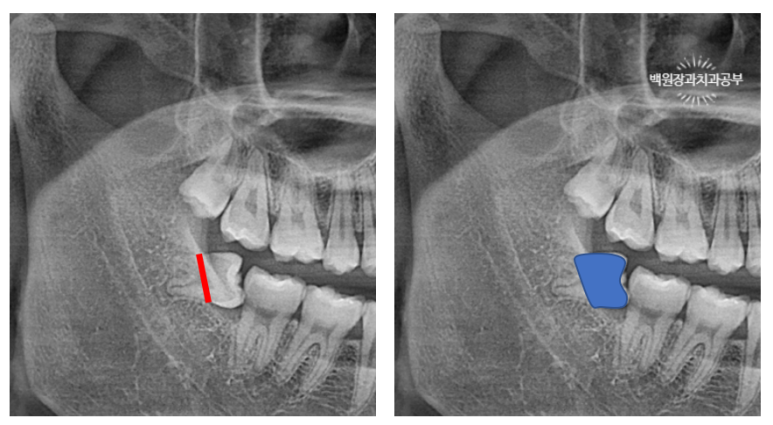 매복 사랑니 10분만에 뽑기! 치료과정/치료기간/비용/후기. 관련 이미지 5