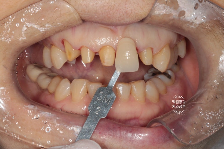 삐뚤빼뚤 앞니 세로 금  - 신경치료 없이 지르코니아 크라운으로. 상악동뼈이식술 임플란트. 관련 이미지 6